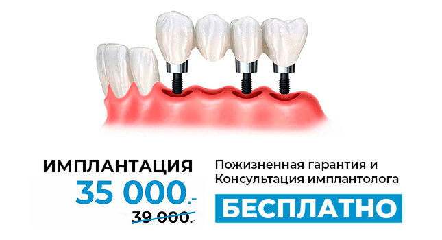 Акция - Имплантация за 22 990!